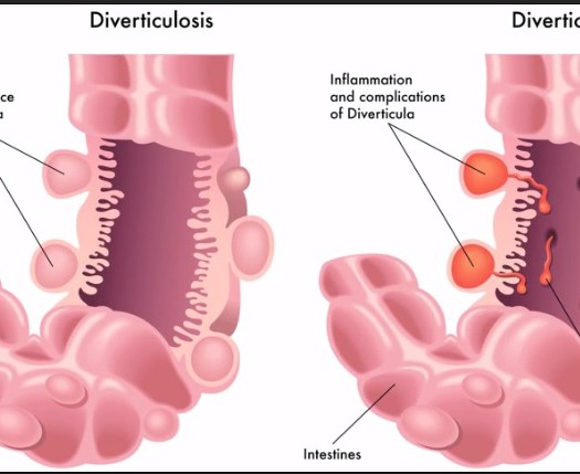 Diverticulitis nhs diet sheet